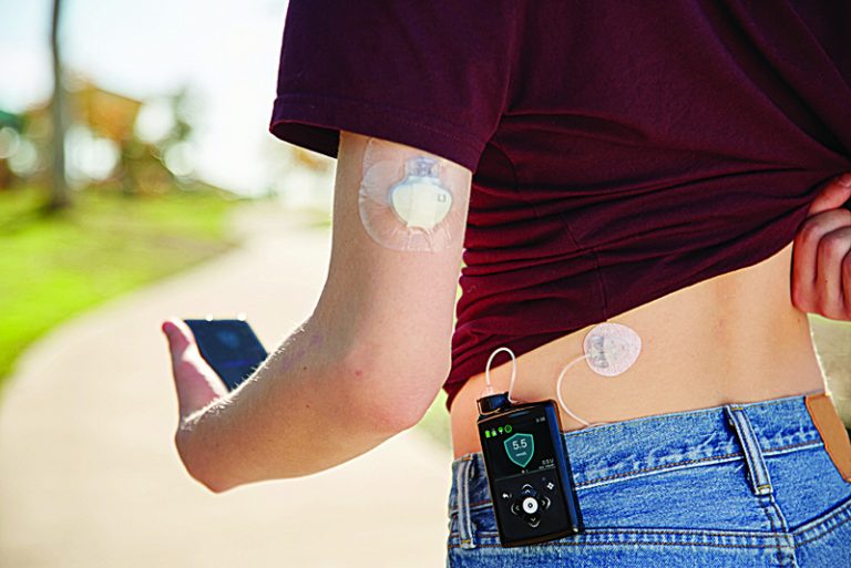 Decisão da Vara Única de Ipubi obriga operadora a custear o sistema MiniMed 780G, sensor Guardian 4 e insumos em até cinco dias, sob pena de multa diária.
